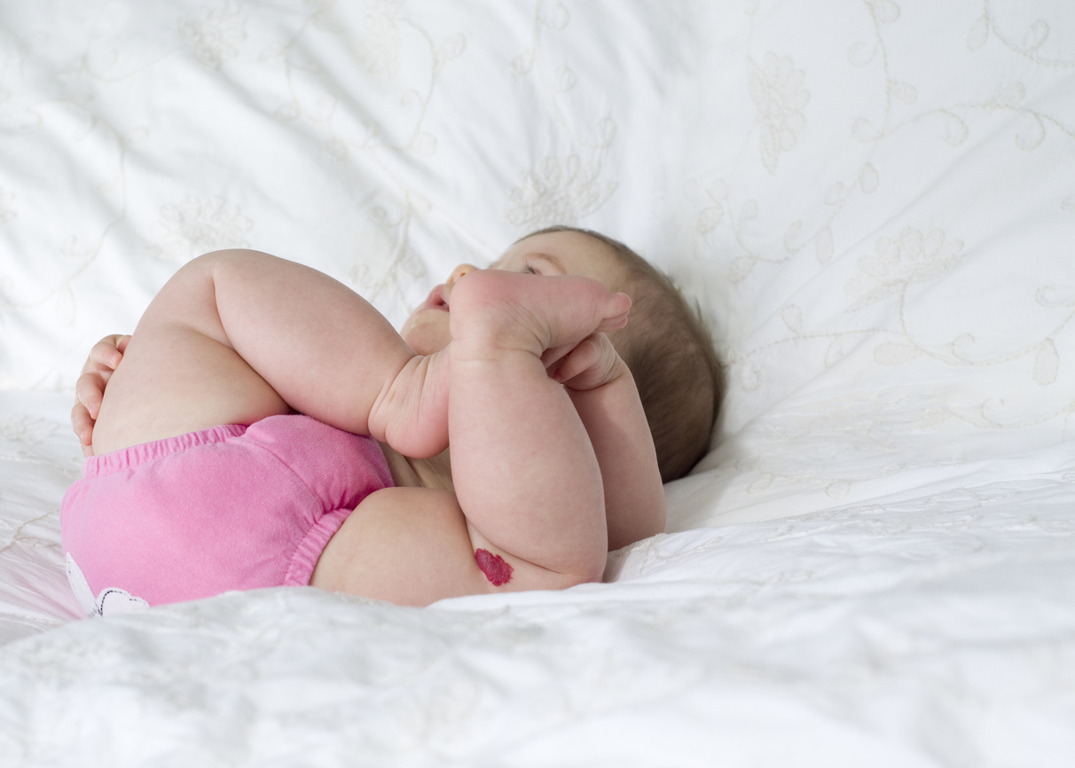 Когато бебето се роди с „винено петно“ 