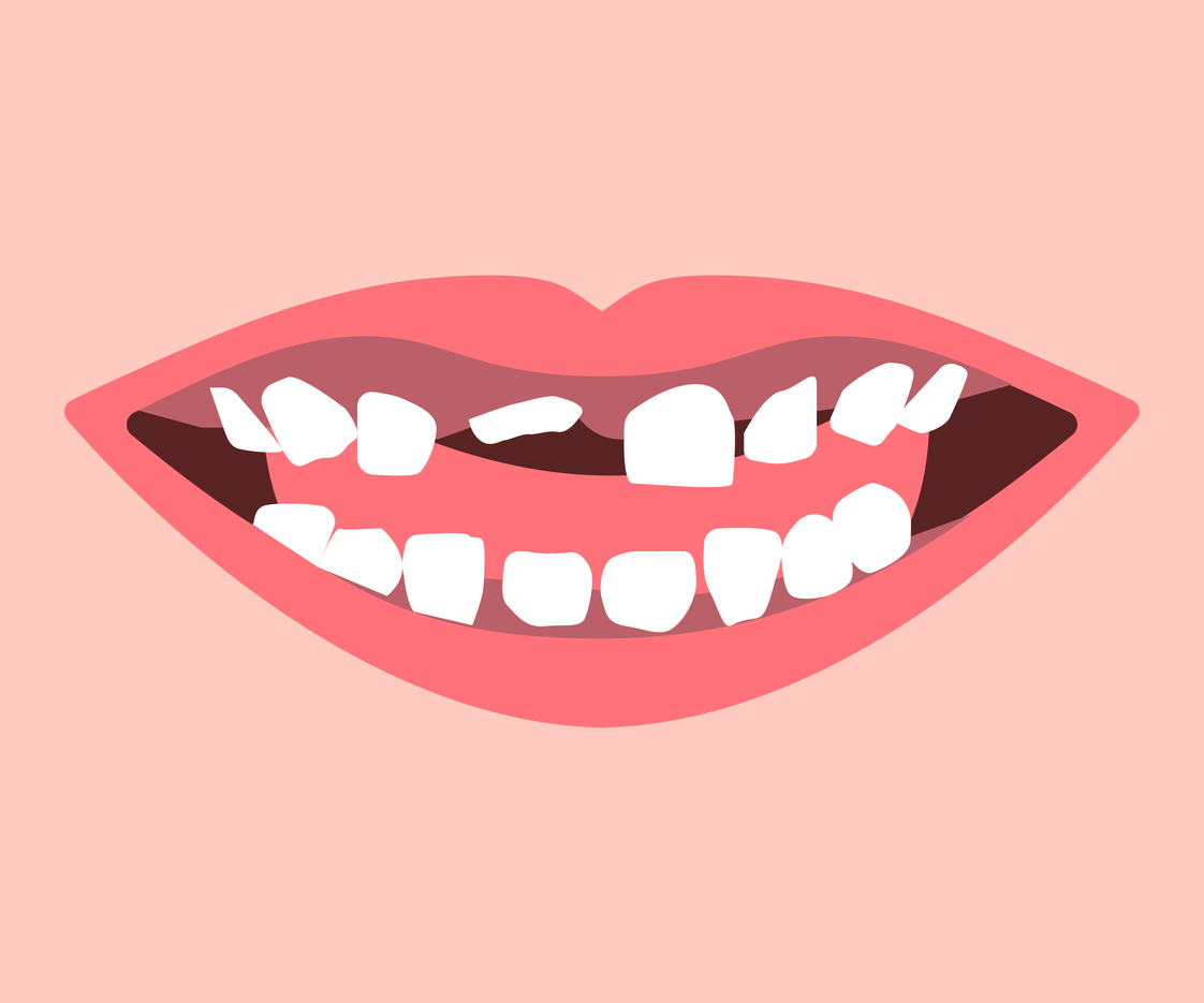Кога и защо се налага да извадим млечния зъб  