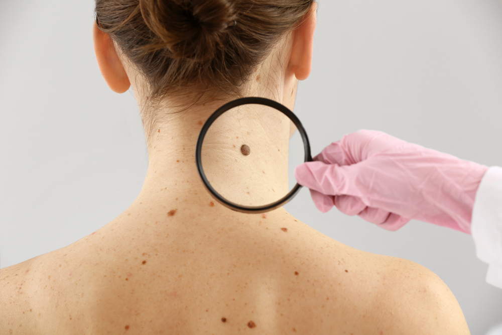 Безплатни прегледи за ранно откриване на рак на кожата 