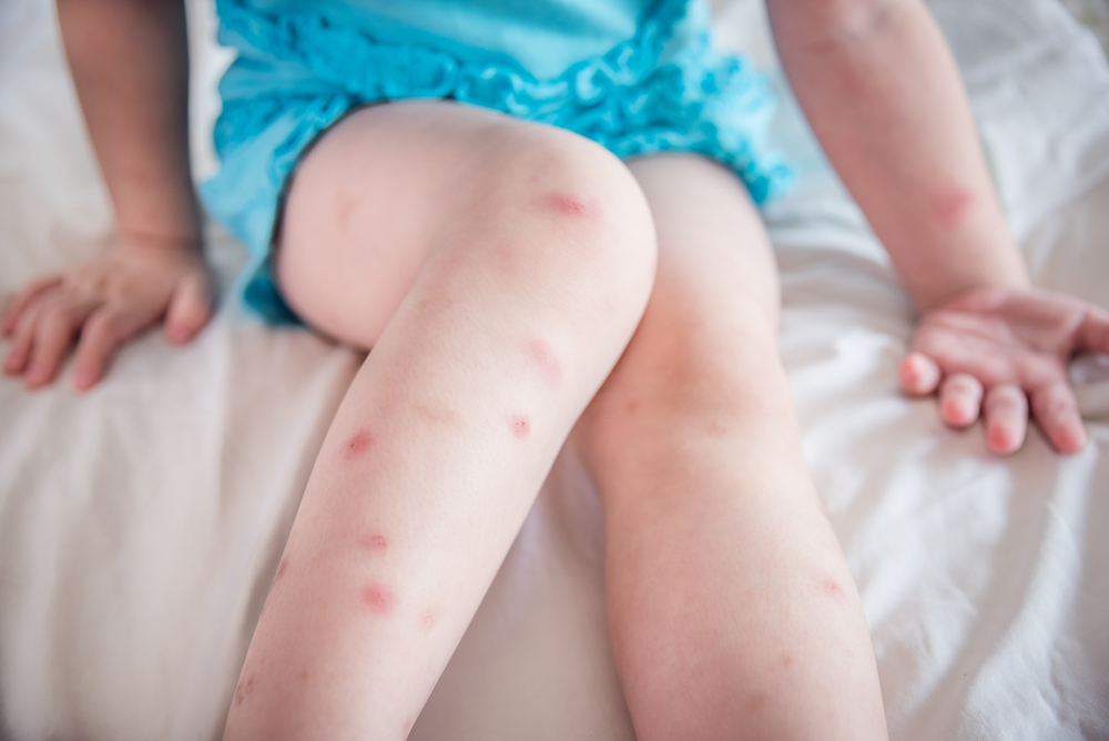 Дете със симптоми на западнонилска треска в Русе 
