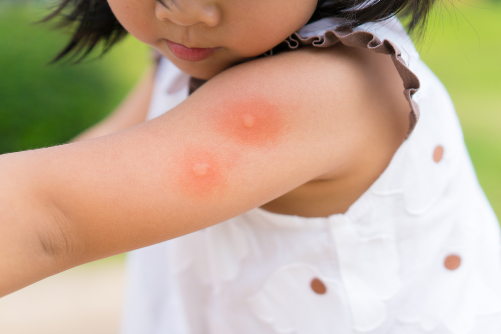 5 алергични реакции при ухапване от комар  