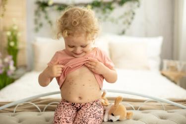 Варицелата отново набира скорост  